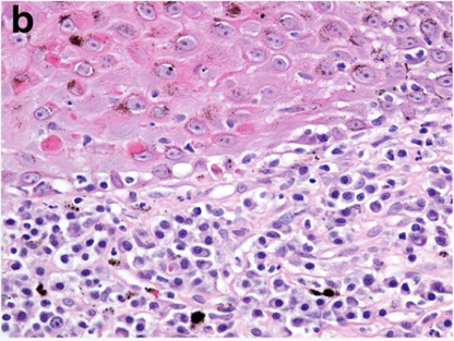 lymphos + plasma cells, blurring between epidermis & dermis