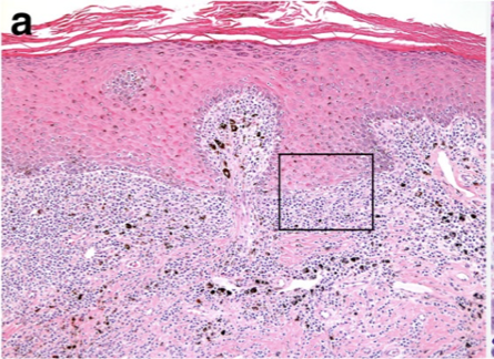 hyperkeratosis in top layer