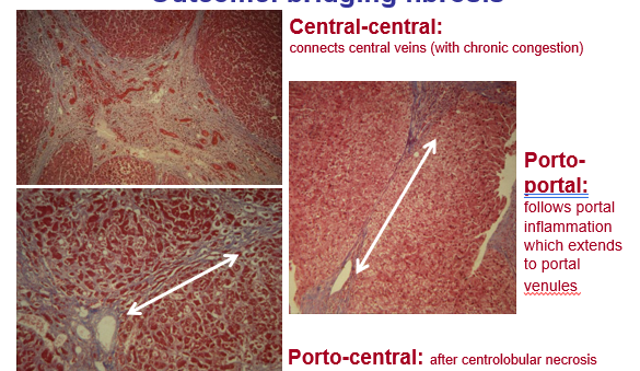 depends on where necrosis started + underlying cause